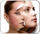 Tratamento_Dermatologia_Estética_Facial_Corpora_Ribeirão Preto Acne