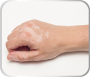 Tratamento_Dermatologia_Estética_Facial_Corpora_Ribeirão Preto Vitiligo