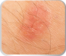 Tratamento_Dermatologia_Estética_Facial_Corpora_Ribeirão Preto Micoses