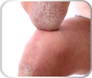 Tratamento_Dermatologia_Estética_Facial_Corpora_Ribeirão Preto Psoríase